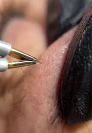 Cımbızlı epilasyon 